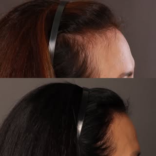 One year and one month ago, this patient came to me feeling like her hairline was thinning at her te