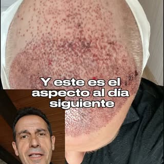 🚨 Hay algo que casi nadie te cuenta sobre el trasplante capilar...

El cambio no ocurre de un día p