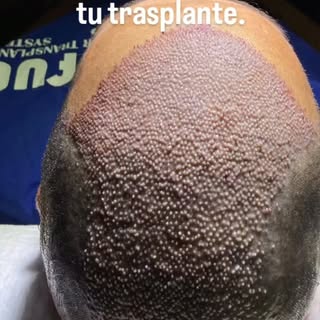 🚨 Un solo error durante el primer lavado puede poner en riesgo el resultado de tu trasplante capila