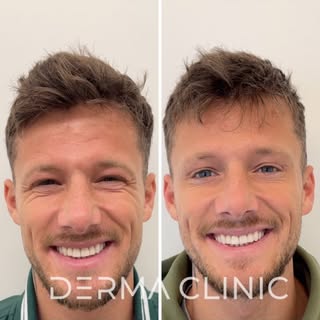 Botox 3 zonas na Derma Clinic? 😏

- Resultados duradouros, clean e sobretudo: naturais! ☺️

Marque 