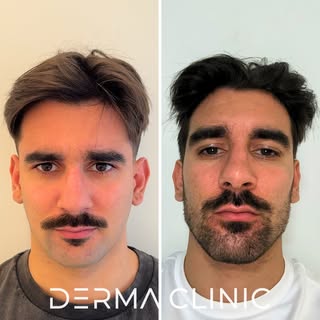 Desta vez o @vaaires7 veio fazer harmonização de mandíbula, com ácido hialurónico.
Os resultados são