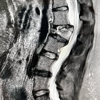 L2 burst fracture causing compression on the Cauda equina.  2 stage procedure.  1.  Lateral corpecto