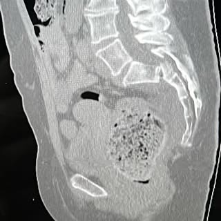 61 year old female who fell in the shower and sustained and unstable sacral fracture.  In order to g