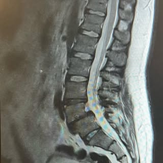 38 year old male with a grade 1 spondy.  Back pain and radicular pain going down bilateral legs.  6 
