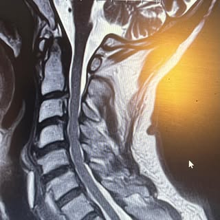 Older gentlemen involved in a motor vehicle accident who had weakness, radiculopathy.  C3-c7 laminec