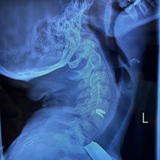 We loooooooooove to preserve motion if we can! Young athletic female with C6 radiculopathy underwent
