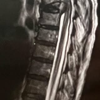 Elderly woman with epiglottic cancer presents with acute onset of bilateral paraplegia due to pathol