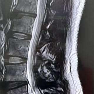 33 year old male with constant numbness and tingling going into the l4,5 and S1 distributions.  He u
