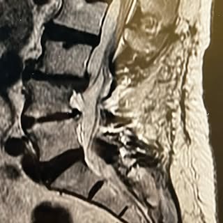 69 year old female with several lumbar decompressions in Ecuador.  Complaining of constant pain walk
