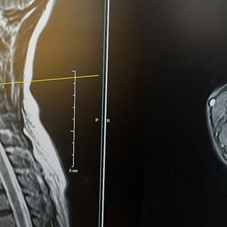 39 year old female with herniated discs at c4-5 and c5-6 causing compression upon the C5and C6 nerve