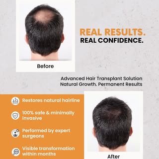 From thinning to winning 🧠➡️💇‍♂️
Grow your confidence back with Dinaaz Hair Transplant!

📞 Book y