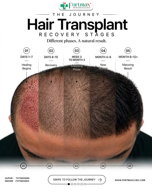 Hair Transplant Recovery Journey 🧑‍🦱✨
From healing and recovery to shedding, new growth, and the f