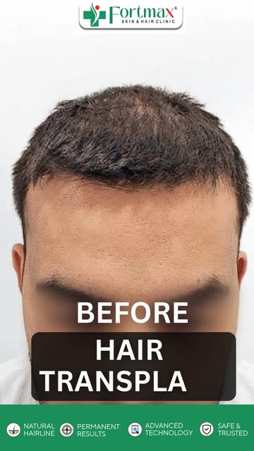 Real Results. Renewed Confidence. ✨
A natural-looking hairline, improved density, and confidence res