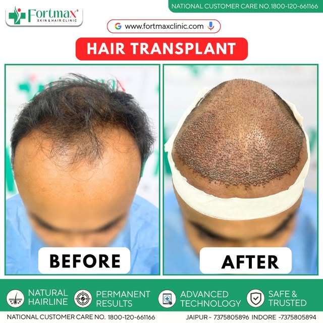 Hair transplant surgery is designed to restore hair density while maintaining a natural-looking hair
