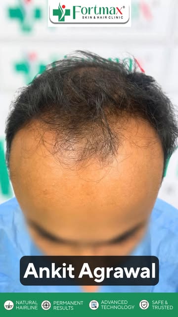 Hair transplant surgery is designed to restore hair density while maintaining a natural-looking hair