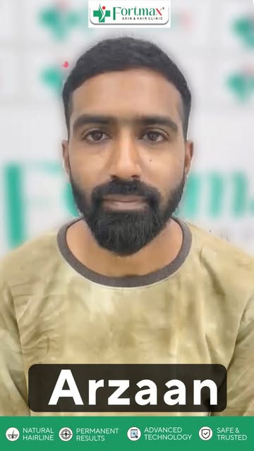 ✨New Hair Transplant Result ✨
 Another transformation, another confident new look.Natural growth. Im