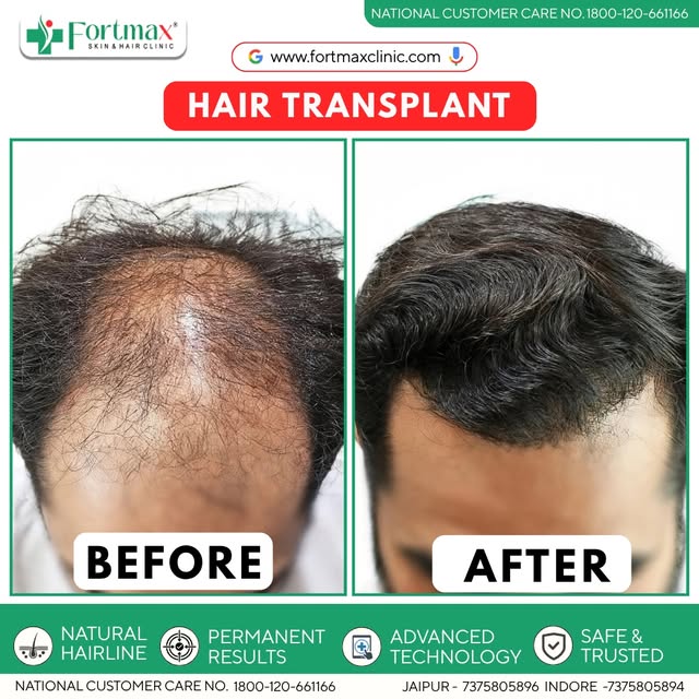 ✨A New Hairline. A New Confidence. Say goodbye to hair loss and hello to a naturally fuller look! 🌱