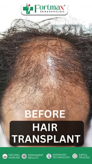 ✨A New Hairline. A New Confidence. Say goodbye to hair loss and hello to a naturally fuller look! 🌱