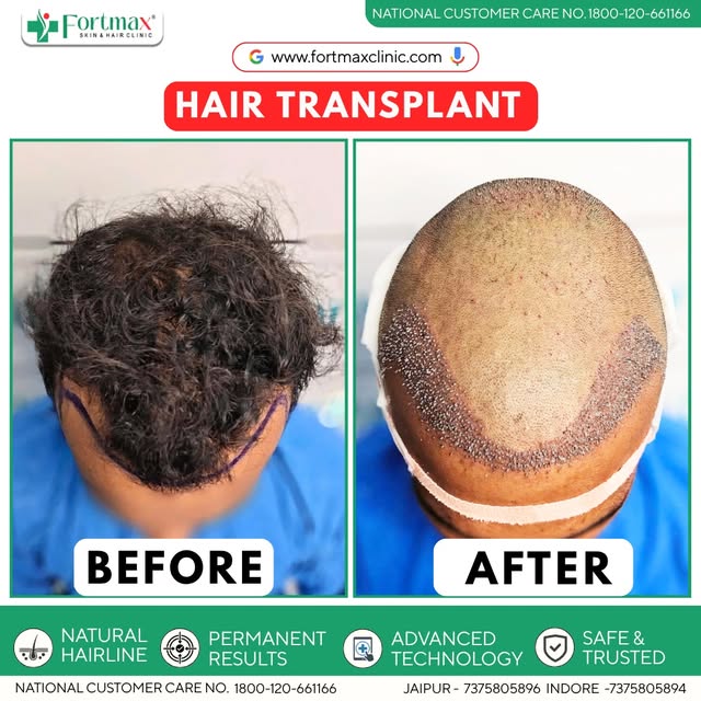 A fresh start for a fuller tomorrow. ✨🌱 Hair transplant surgery done—now it’s time to trust the pro