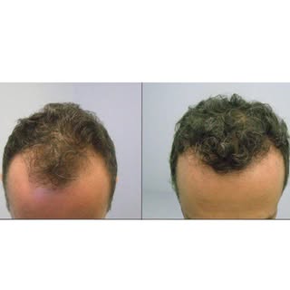 2,686 Graft Hair Transplant