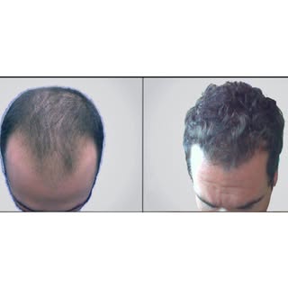 3,224 Graft Hair Transplant