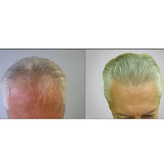2,444 Graft Hair Transplant.