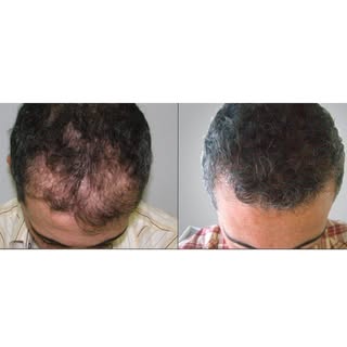 1,895 Graft Hair Transplant