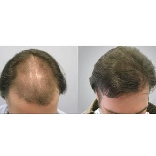 3,718 Graft Hair Transplant