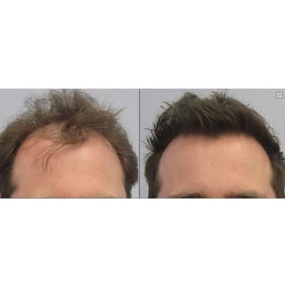 3,450 Graft Hair Transplant