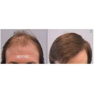 2,500 Graft Hair Transplant.