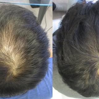 PRP for hair loss 😍