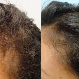 Before and after. Female PRP injection at 6 months.