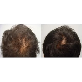 PRP injections, 9 months post treatment.