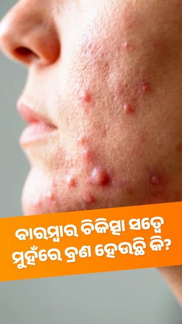 ମୁହଁରେ ବାରମ୍ବାର ବ୍ରଣ(#acné ) ହେଉଛି କି? 🤔

ବ୍ରଣକୁ କେବଳ ଚାପିଦେବା କିମ୍ବା ଘରୋଇ ଉପାୟରେ ଠିକ୍ କରିବା ସବୁବେଳ