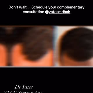 #fue #hairtransformation #hairloss #viralreels