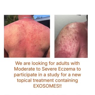 #eczema #eczematherapy #chicago