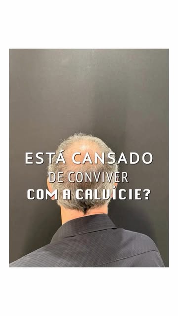 Você, você mesmo: cansado de conviver com a calvície? 🗣️

Transplante capilar é coisa séria e você 