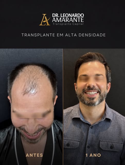 Alta densidade: o segredo para um resultado natural. 

Este paciente apresentava um quadro de calvíc