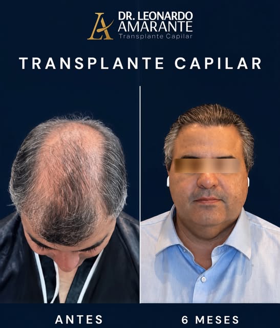 O tempo passou, o resultado ficou. ⏳

6 meses após o transplante capilar: densidade, naturalidade e 