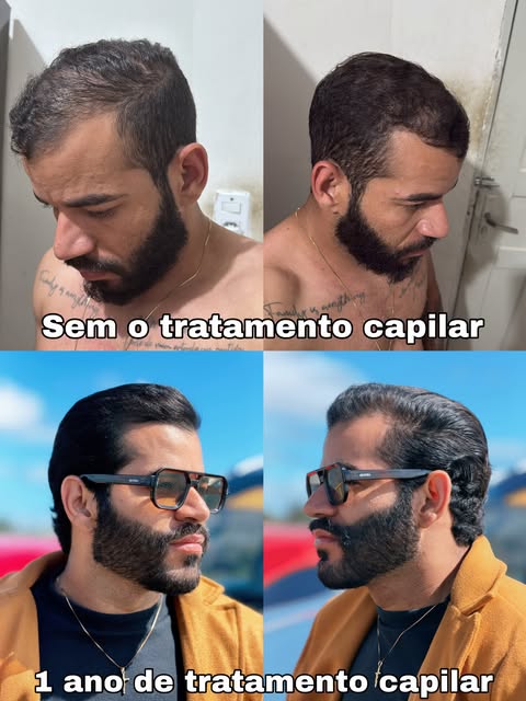 O resultado de um ano de tratamento capilar com a Fio Implante, do Dr. Ícaro, mostra como o cuidado 