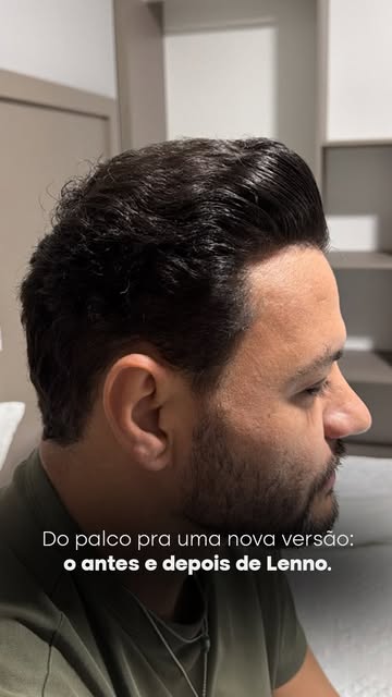 Uma mudança que vai além dos fios. 🌟
O resultado de um transplante capilar bem planejado aparece na