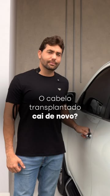 O cabelo transplantado tende a permanecer, mas isso não significa que a calvície acabou.
Os fios tra