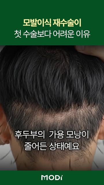 모발이식 재수술이 어려운 이유!
#모발이식 #모발이식재수술 #탈모 #비절개모발이식 #헤어라인교정