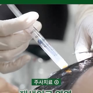 탈모약 먹는데도 부족하다면..?!
#모발이식 #탈모치료 #탈모약 #탈모 #강남모발이식