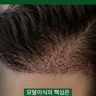 모발이식 오래 유지하는 방법..?!👍🤩

#모발이식 #탈모치료 #탈모 #강남모발이식 #남성탈모