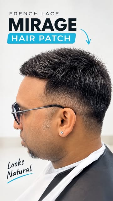Skeptical at first… but the final look changed everything. 👀
When a hair patch looks this natural, 