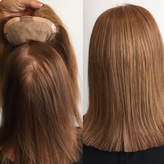 ✨𝚃𝚑𝚒𝚗𝚗𝚒𝚗𝚐 𝙷𝚊𝚒𝚛✨
The most common cause of hair loss is a hereditary condition called fema