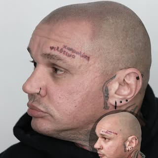 Check out this transformation! After 2 SMP sessions a natural realistic hairline and treatment was t