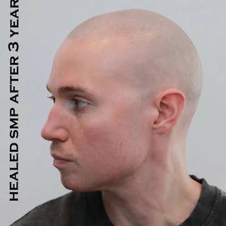 Healed results of a nice light subtle look after 3 years. This is my client after receiving 3 sessio