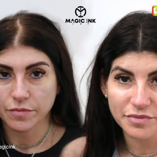 The "Pocahontas" is one of Scalp Micropigmentation styles. SMP is an ideal solution for any type of 
